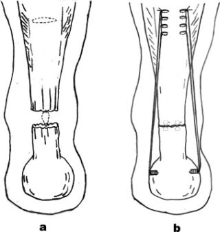 Achilles Reconstruction Illustration