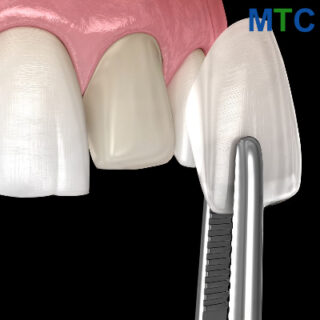 Dental Veneers in Costa Rica