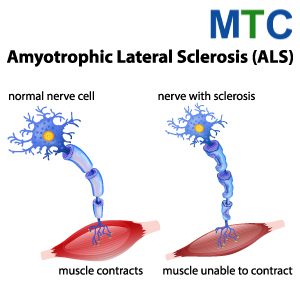 Amyotrophic Lateral Sclerosis