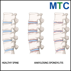 Ankylosing Spondylitis