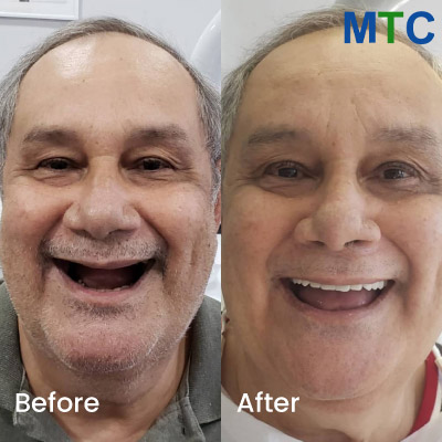 Dental Implants in Rio de Janeiro, Brazil