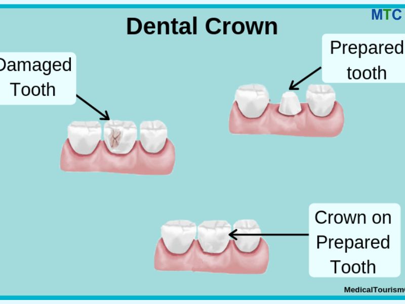 Dental Crowns in Croatia