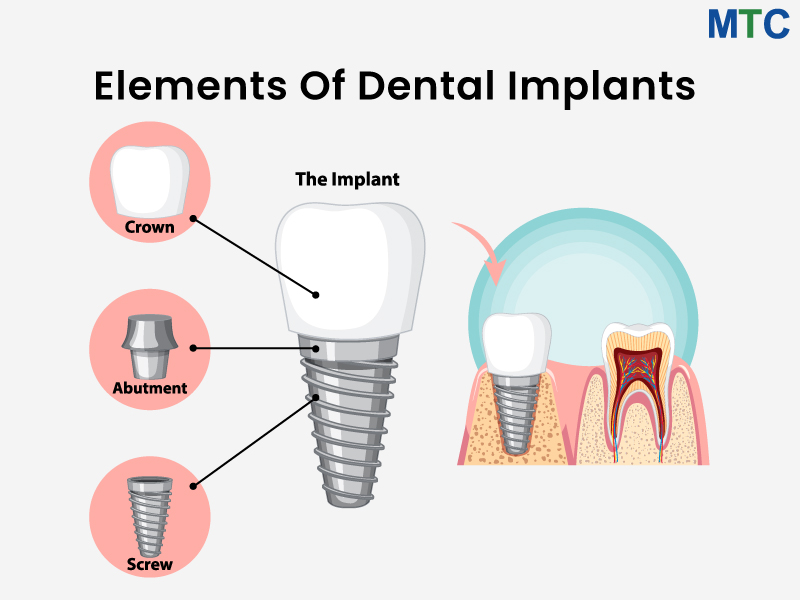 Elements of Dental Implant