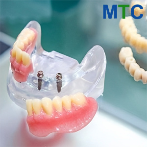 Mini Dental Implants