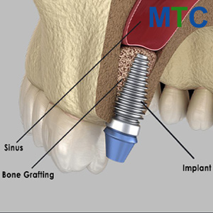 Sinus Lift in Mazatlan