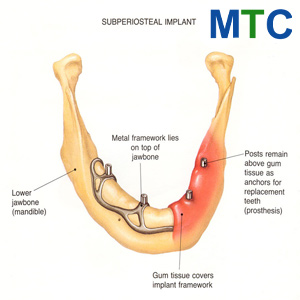 Subperiosteal Dental Implants