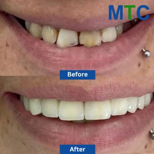 Veneers before and after Trogir