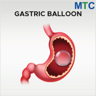 Intragastric Balloon, Bursa