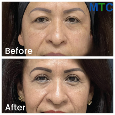 Before/After Blepharoplasty