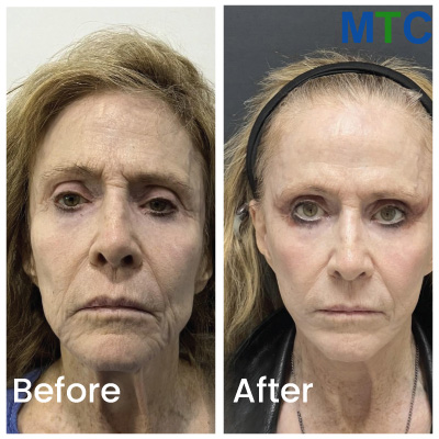 Before/After Necklift & Facelift