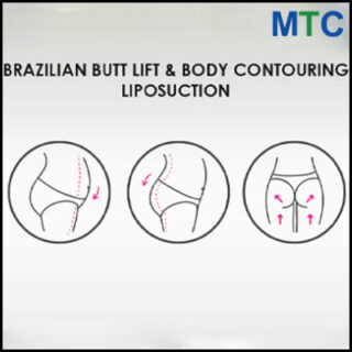 Brazilian Butt Lift