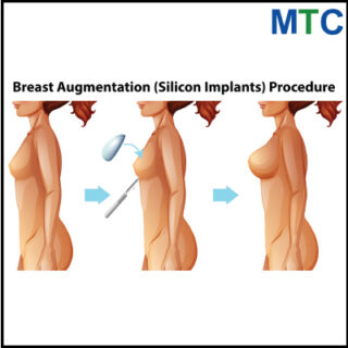 Breast Implant Surgery