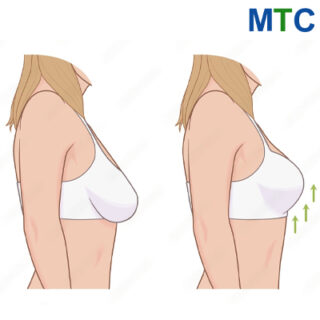 Breast Lifting