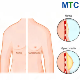 Gynecomastia