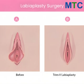 Labiaplasty