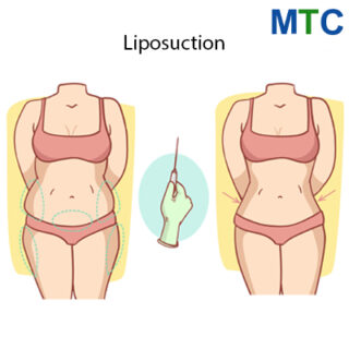 Liposuction