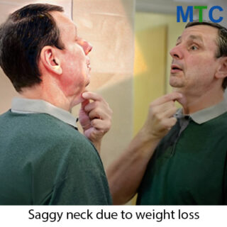 Saggy Neck