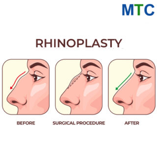 Rhinoplasty