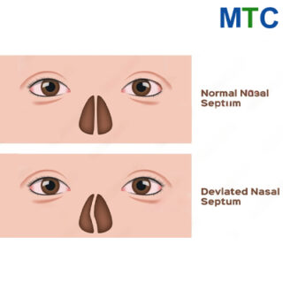 Deviated Nasal Septum