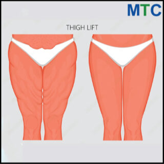 Thigh Lift