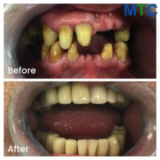 Full mouth restoration in Crete, Greece