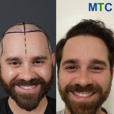 Turkey Hair Transplant Before and After