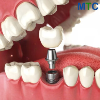 Traditional dental implant in Mazatlan