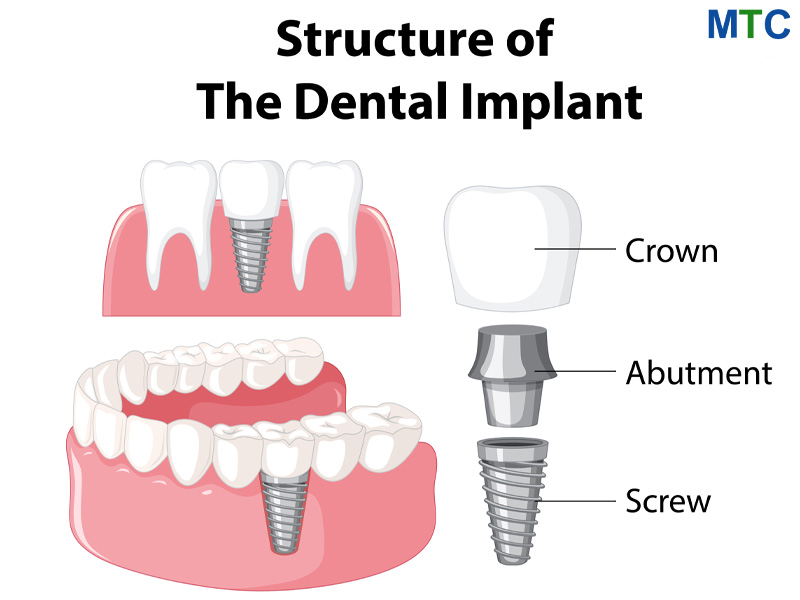 Dental Implant Structure