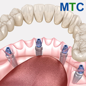 All on 4 Dental Implants