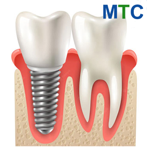 Dental Implant 