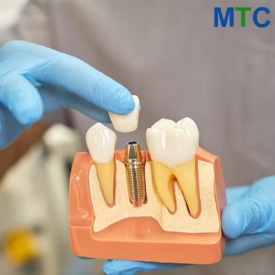 Dental implant model