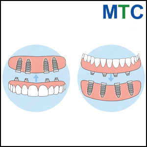 Immediate Load Dental Implants in Mazatlan