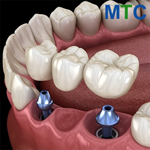 Dental Bridge