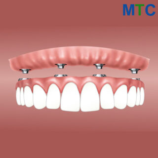 Overdenture in Mazatlan