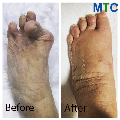 Advanced Hallux Valgus and Foot Deformation