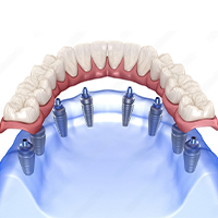 All on 8 implants in Chisinau