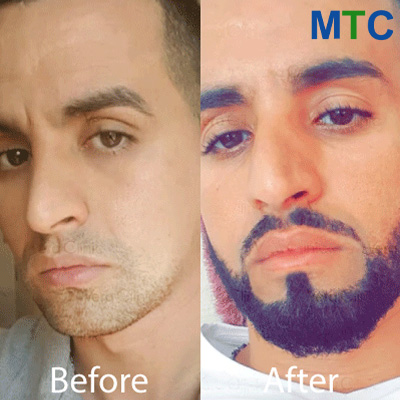 Before & After | Beard Transplant Turkey