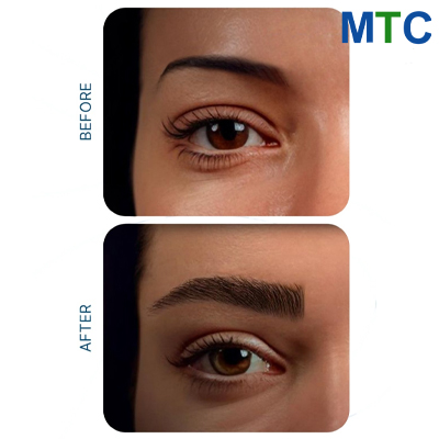 Eyebrow Transplantation Turkey