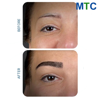 Eyebrow Transplant in Turkey