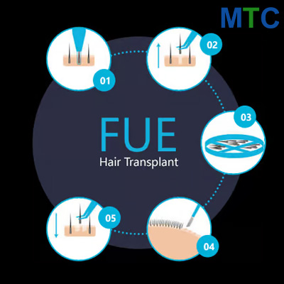 FUE Beard Transplant Turkey