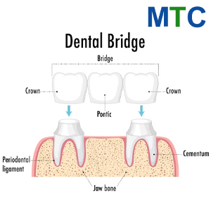 Fixed Partial Denture Los Algodones