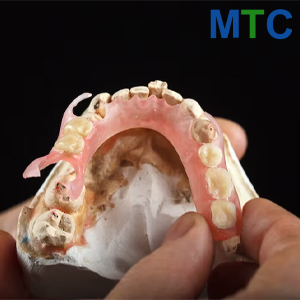 Resin Based Partial Denture Los Algodones