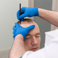 Turkey FUE hair transplant marking