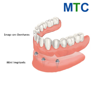 Snap-On Dentures in Vietnam