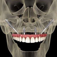 Maxillary Zygomatic Implant