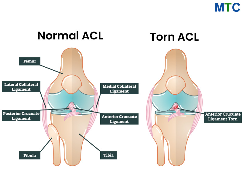 ACL Tear 