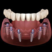 All-on-6-Implants | Izmir, Turkey