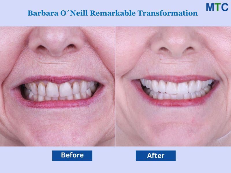 Porcelain Veneers in Los Algodones: Before & After