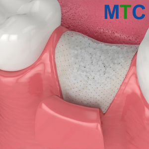 Bone graft in Mazatlan