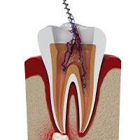 Root Canal Abroad